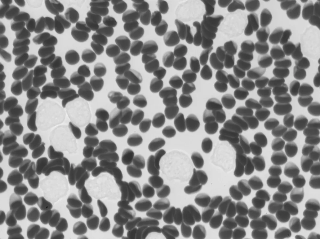 Blood cancer sample imaged by Remoscope