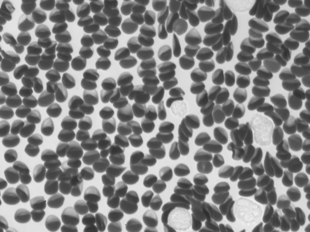 Sepsis sample imaged by Remoscope