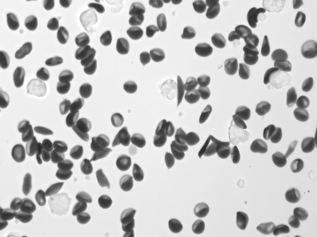 Sickle cells imaged by Remoscope