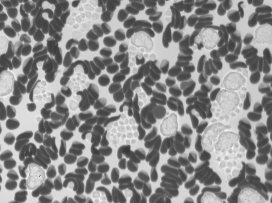 Hematological abnormality imaged by Remoscope