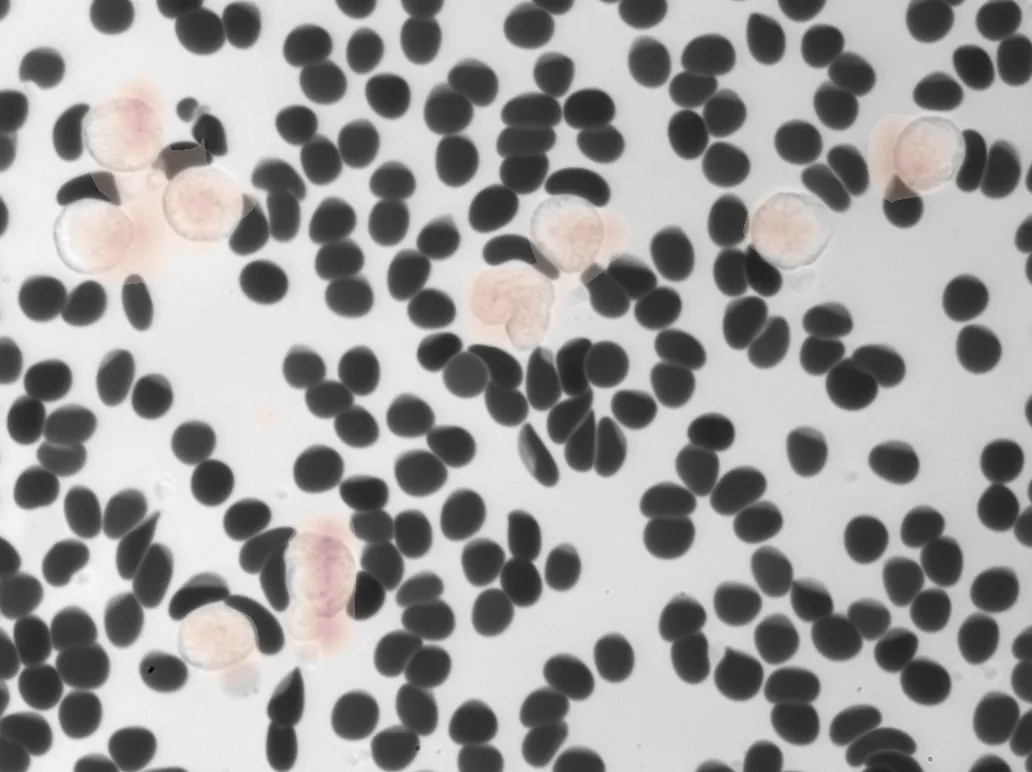 Grad-CAM saliency map highlighting disease state features for sepsis classification